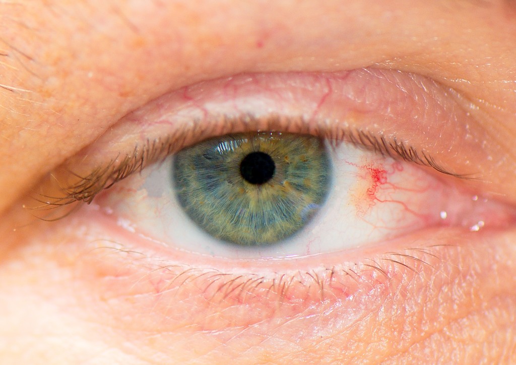 _DSC7038test.jpg - Chris öga. Kännetecken - fick en nagel i ögat när han var liten